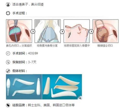 科普隆鼻失败后怎么修复呢(隆鼻失败要怎么修复)图8