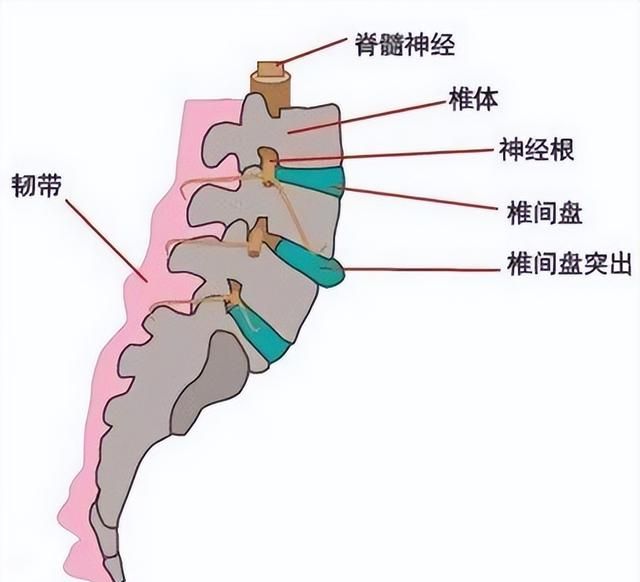 同样都是腰椎间盘为何你如此突出图3