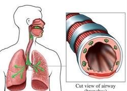 气管炎和支气管炎的用药有何区别图1