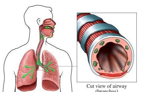 气管炎和支气管炎的用药有何区别图2