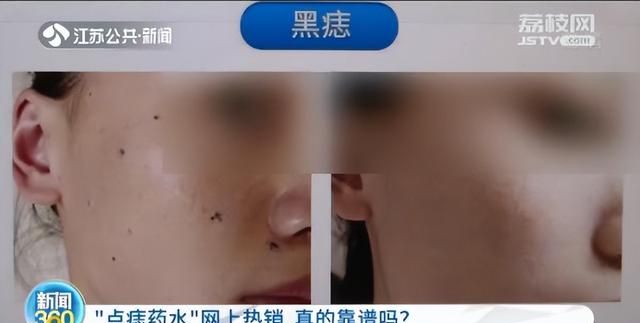 点痣药水网上热销真的靠谱吗(网上售卖的点痣药水可靠吗)图5