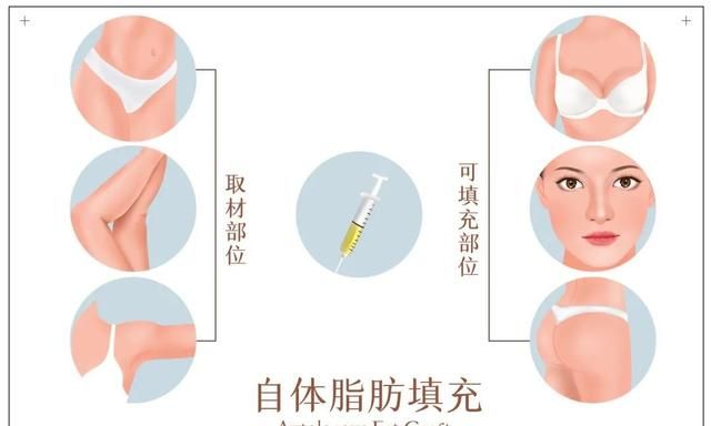 让网红死亡的抽脂手术,到底有多少风险呢图4