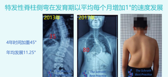 含胸驼背高低肩一定是脊柱侧弯吗图1