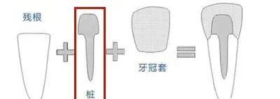 牙齿中间一个大窟窿需要打桩吗,在什么情况下牙齿需要打桩图2