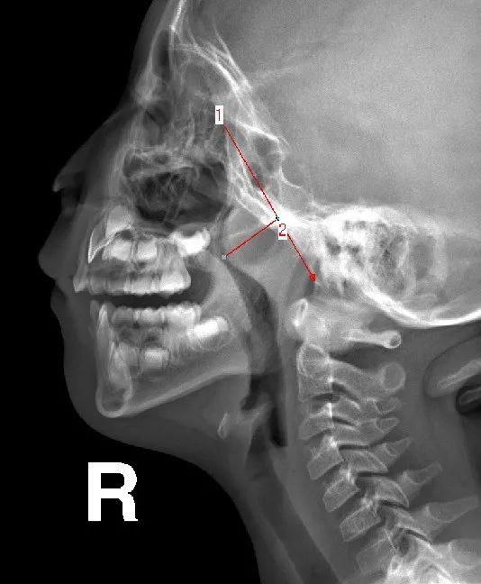 腺样体肥大的x线测量讲解(腺样体肥大ct测量方法)图7