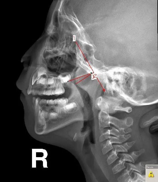 腺样体肥大的x线测量讲解(腺样体肥大ct测量方法)图11