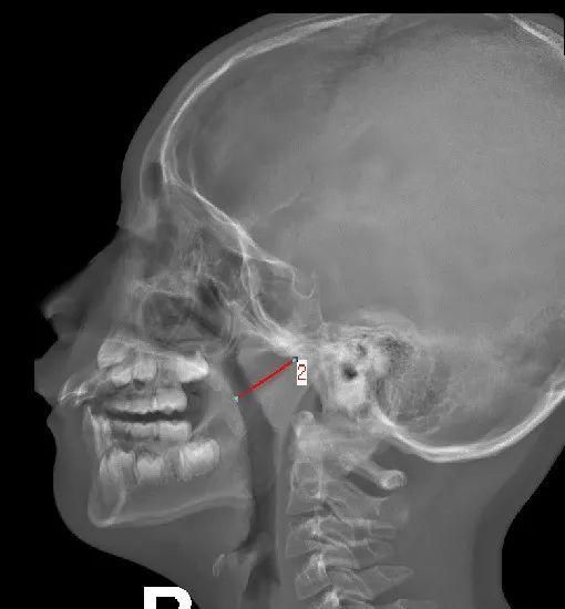 腺样体肥大的x线测量讲解(腺样体肥大ct测量方法)图15