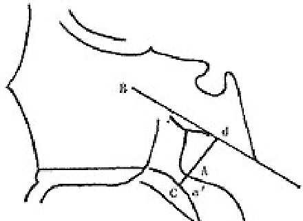 腺样体肥大的x线测量讲解(腺样体肥大ct测量方法)图18