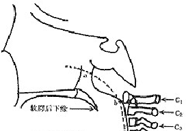 腺样体肥大的x线测量讲解(腺样体肥大ct测量方法)图21