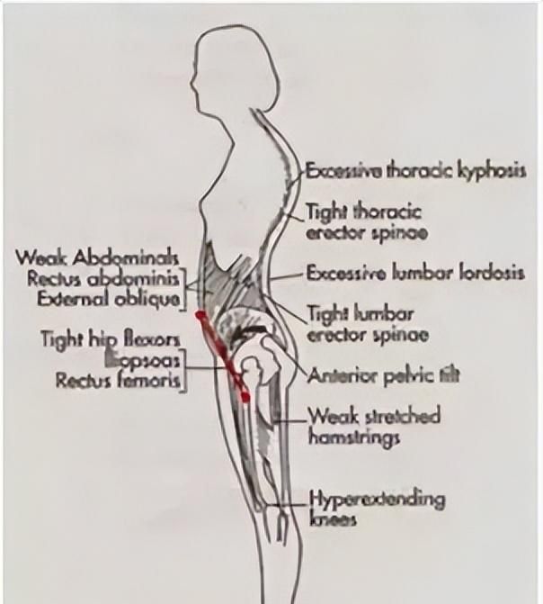 骨盆前倾和骨盆后倾怎么区分怎么矫正图解图4