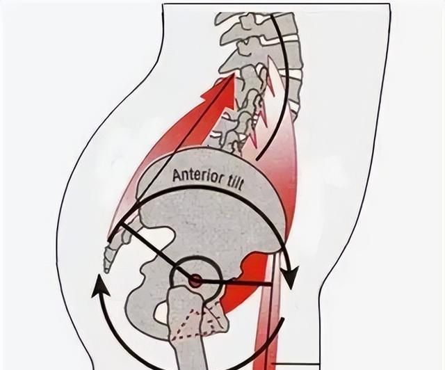 骨盆前倾和骨盆后倾怎么区分怎么矫正图解图7