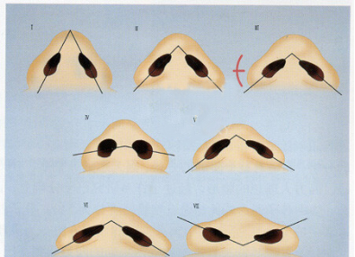 鼻翼缩小是内切好还是外切比较好图4
