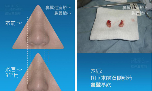 鼻翼缩小是内切好还是外切比较好图13