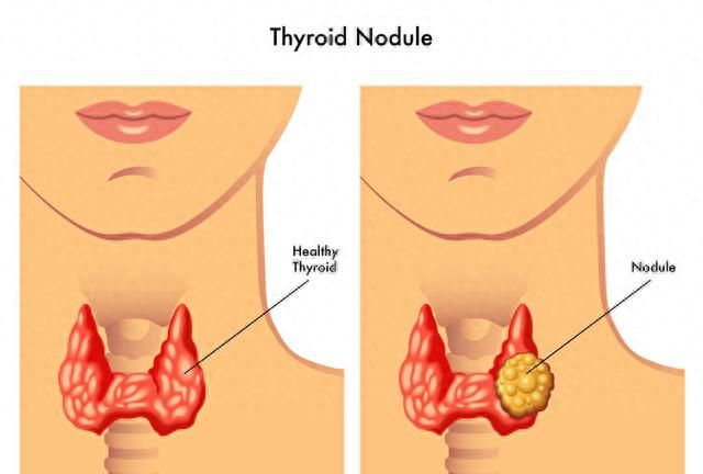 为什么甲状腺结节查出来就钙化了图3