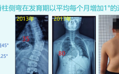 含胸驼背高低肩一定是脊柱侧弯吗